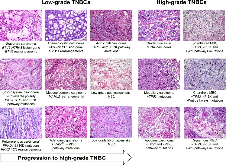 Tumor-infiltrating lymphocytes in triple negative cancer of the breast: the way forward for immune targeting.  - pubmed - ncbi in patients with TNBC